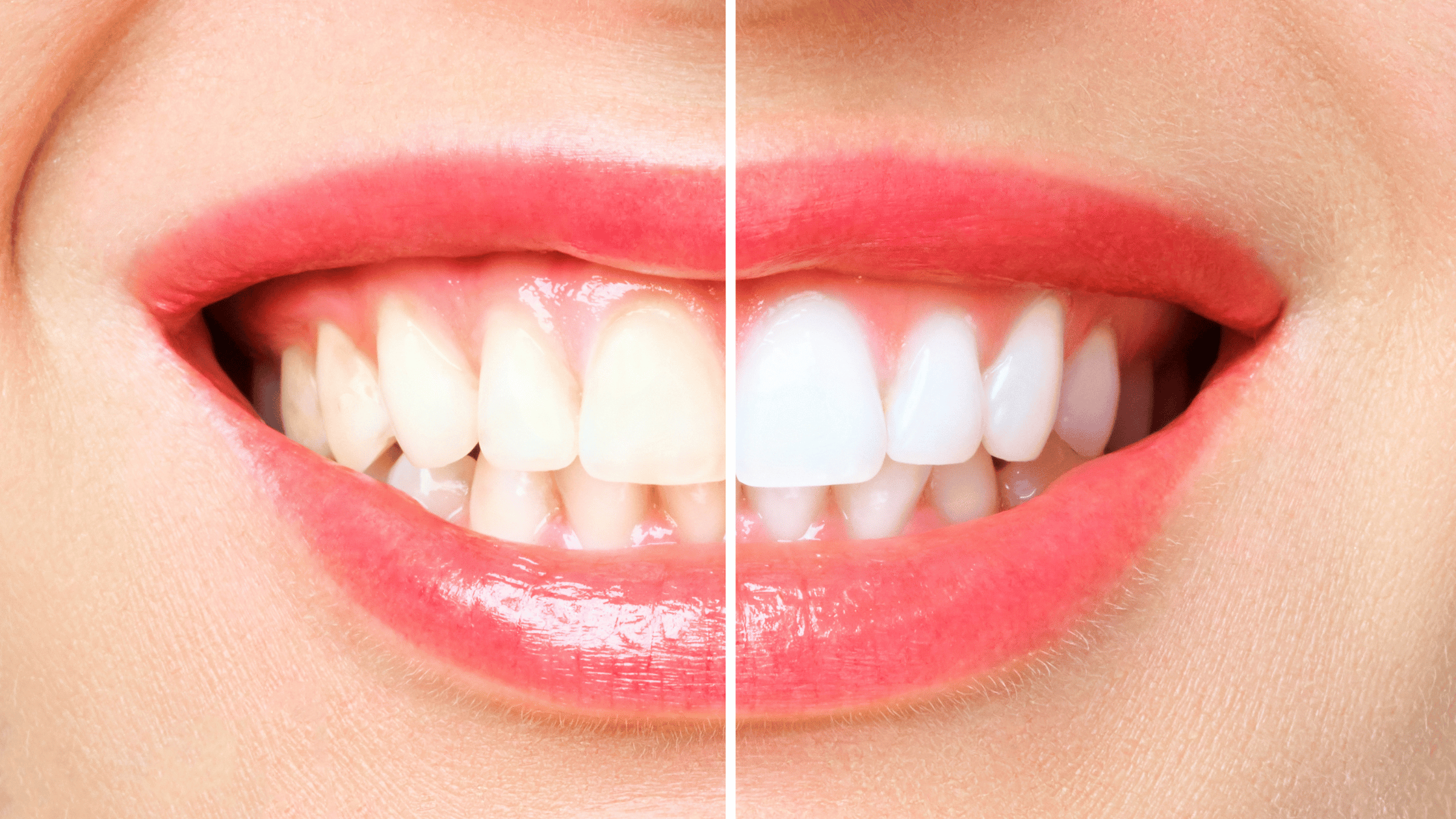 You are currently viewing Teeth Whitening Near Me: How Dental Rescue Can Brighten Your Smile