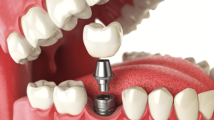 Read more about the article Dental Implants vs. Dentures: Which Option Is Best for You?