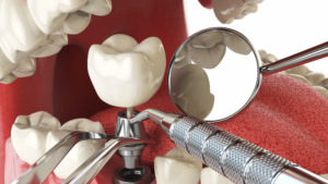Close-up 3D illustration of a dental implant procedure with surgical tools. Dentist placing a titanium implant and crown for permanent tooth replacement.