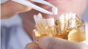 Close-up of a dental professional placing a ceramic crown on a dental implant model. Learn about dental implants in Lahore, their benefits, and how Dental Rescue provides expert implant treatments.