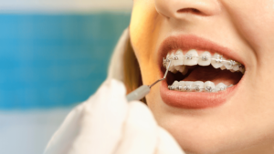 Close-up of a patient receiving a dental check-up with metal braces, highlighting orthodontic treatment for crooked teeth — a common dental problem in Pakistan.
