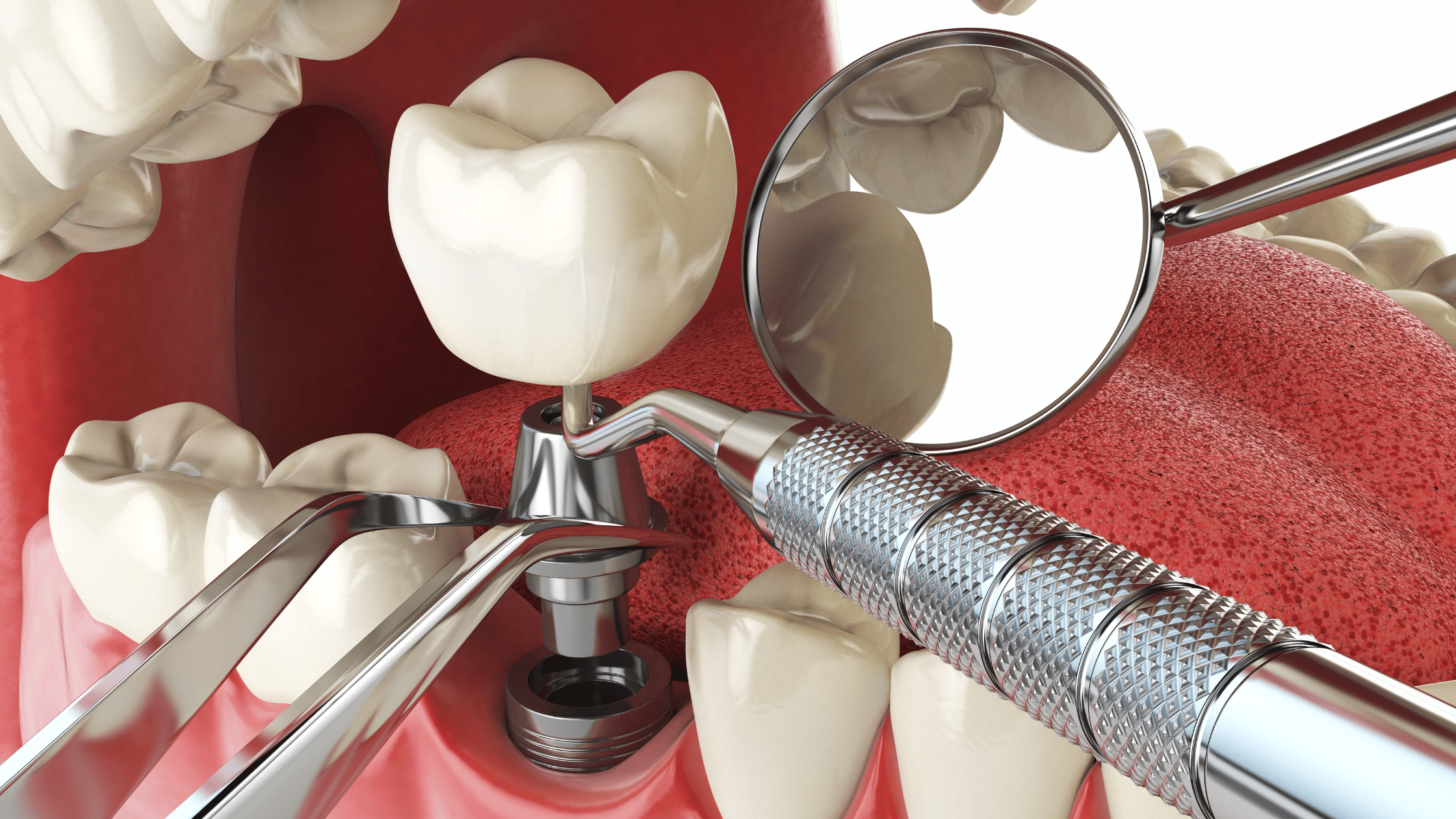You are currently viewing Dental Implants in Lahore: Cost, Procedure & Benefits Explained